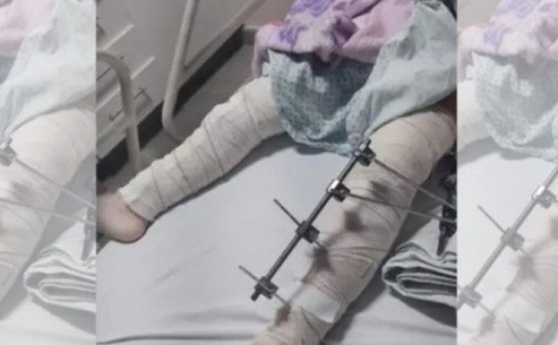 Médicos se confundem e colocam pinos em perna errada de menina de 6 anos